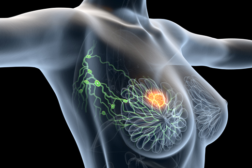 Breast Cancer Treatment and Follow-up Online Forum